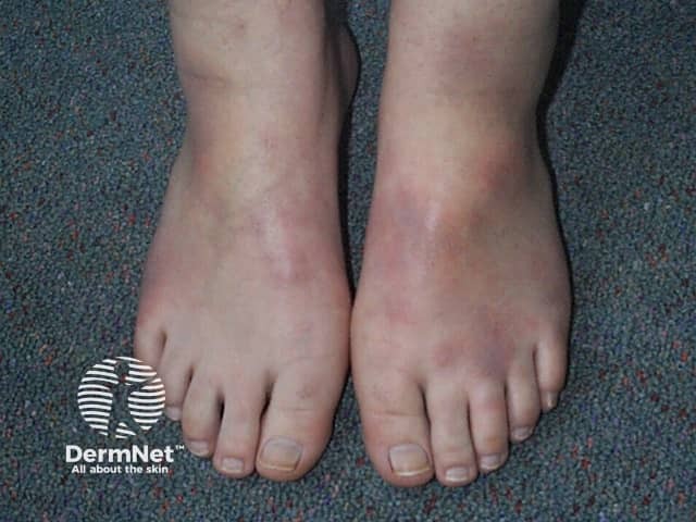 Erythema nodosum