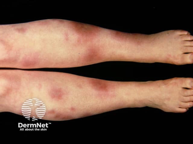 Erythema nodosum