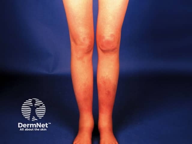 Erythema nodosum