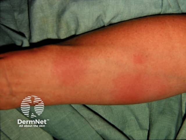 Erythema nodosum