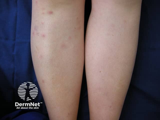 Erythema nodosum