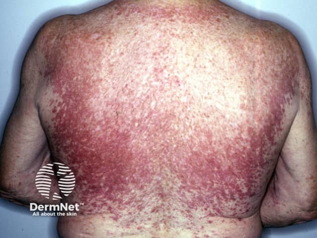 Essential telangiectasia