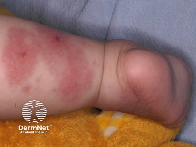 Finkelstein disease or acute haemorrhagic oedema of infancy