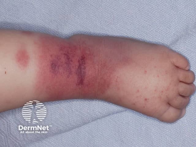 Finkelstein disease or acute haemorrhagic oedema of infancy