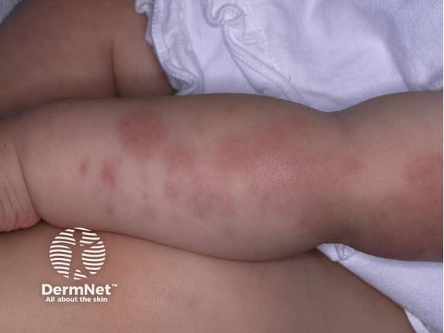 Finkelstein disease or acute haemorrhagic oedema of infancy