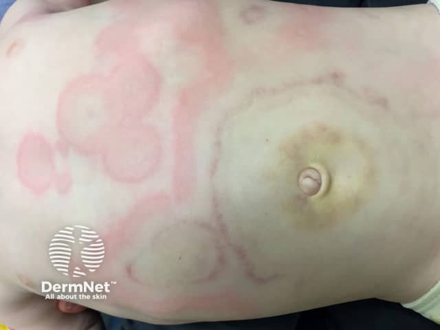 Finkelstein disease or acute haemorrhagic oedema of infancy