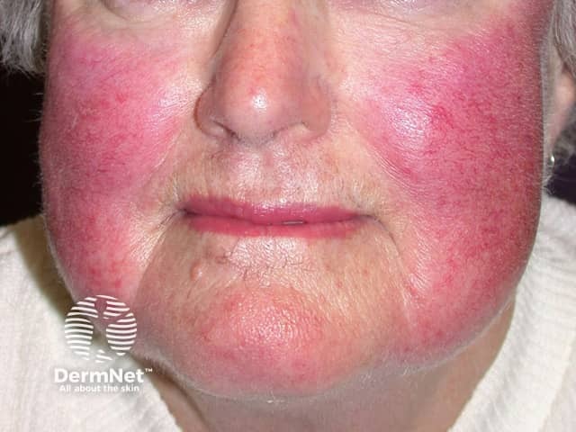 Rosacea causing flushing