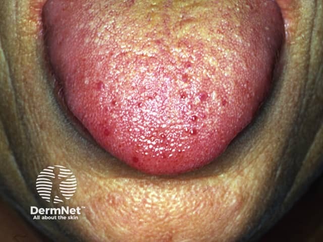 Hereditary haemorrhagic telangiectasia