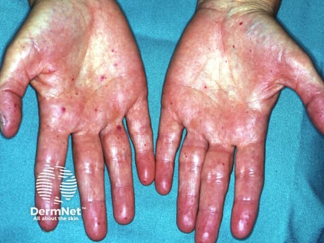 Hereditary haemorrhagic telangiectasia