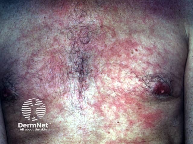 Erythema ab igne