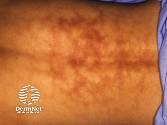 Erythema ab igne