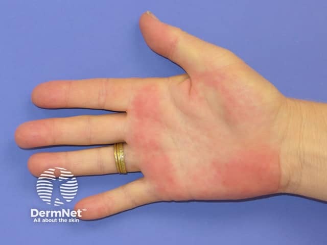 Palmar erythema