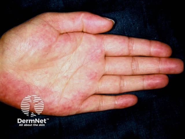 Palmar erythema of liver disease