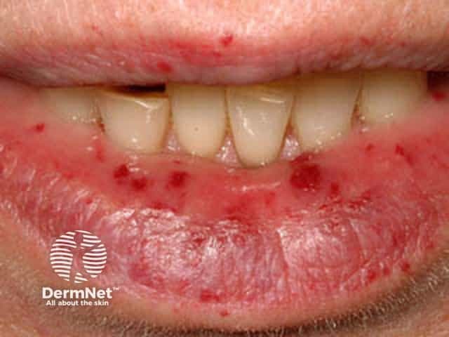 Hereditary haemorrhagic telangiectasia