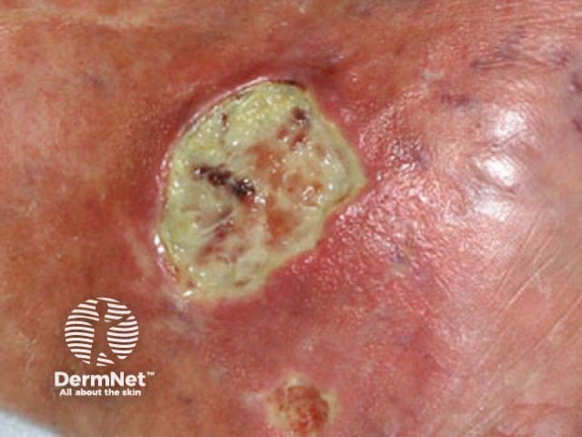 Martorell ulcer