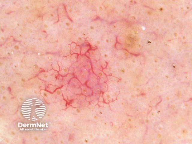 Telangiectasia