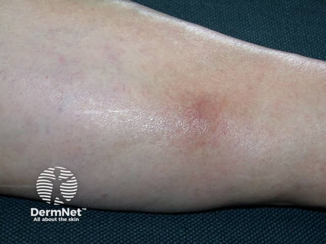 Superficial thrombophlebitis