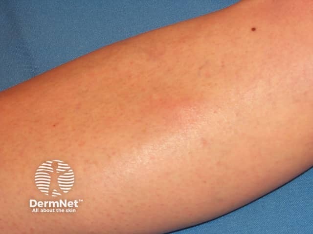 Superficial thrombophlebitis