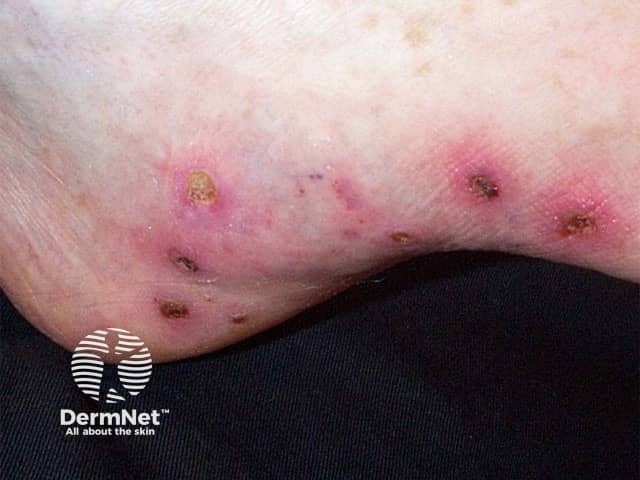 Cutaneous vasculitis