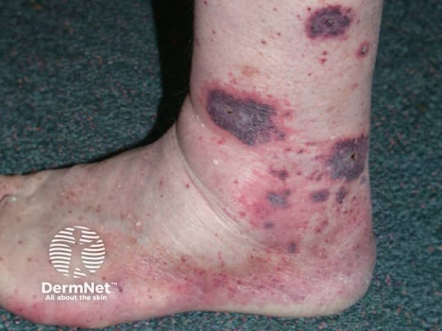 Cutaneous vasculitis