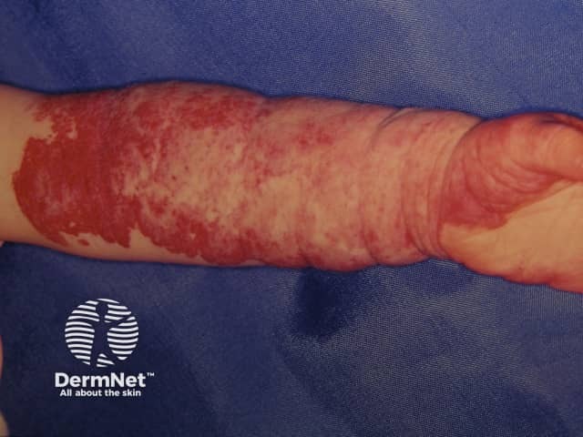 Vascular malformation