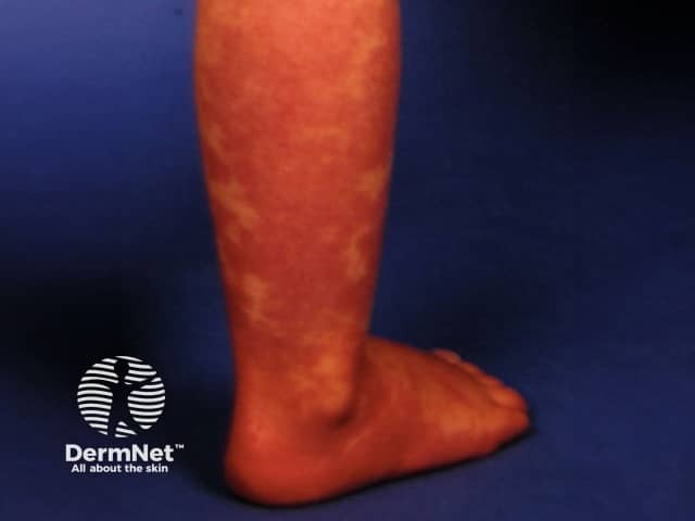 Vascular malformation