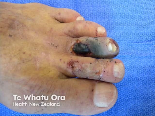 Dry gangrene due to ischaemia