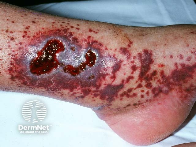 Cutaneous vasculitis