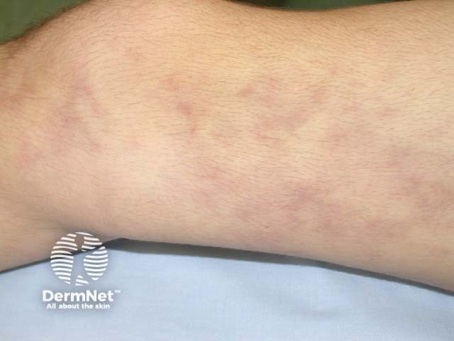 Livedo reticularis in polyarteritis nodosa