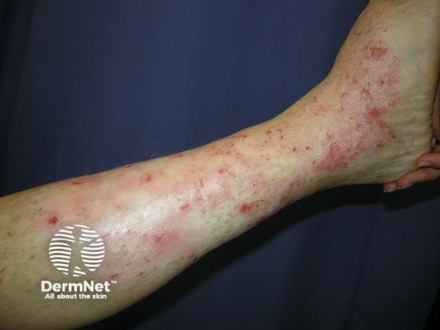 Venous eczema