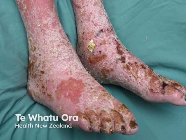 Venous eczema