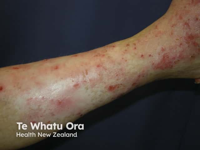 Venous eczema