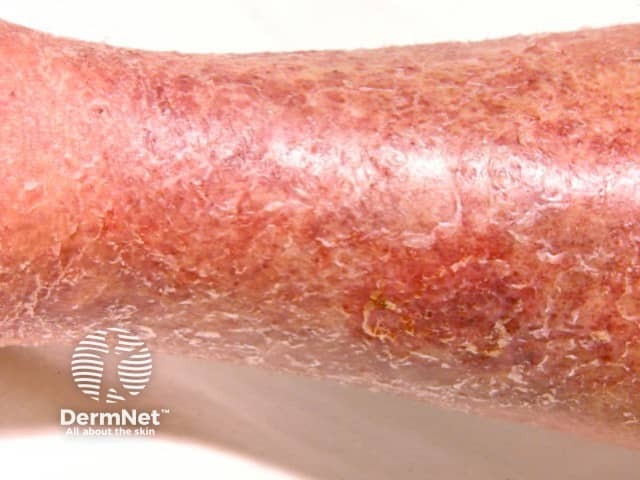 Venous eczema