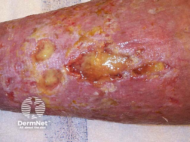 Venous leg ulcer