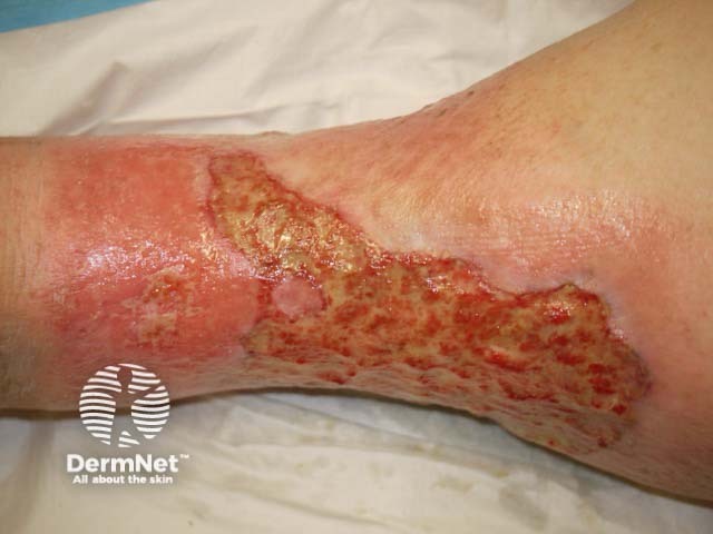 Venous leg ulcer