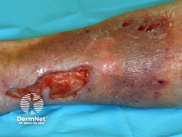 Venous leg ulcer