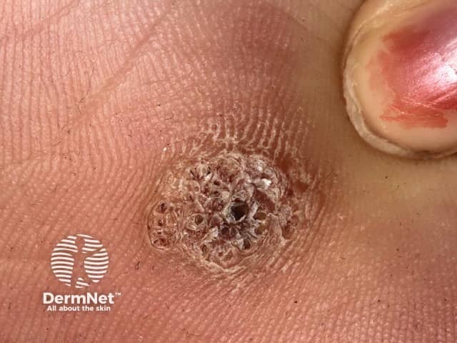 Viral wart