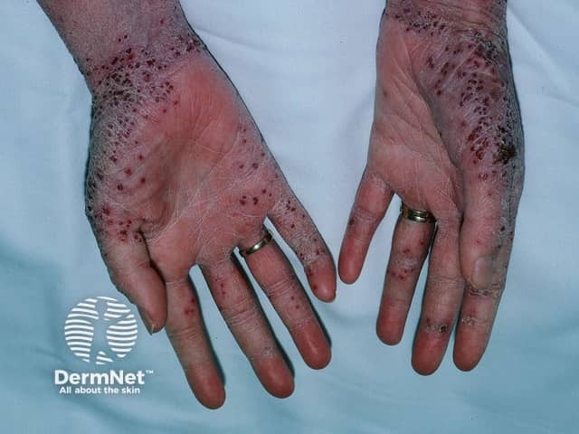 Eczema herpeticum