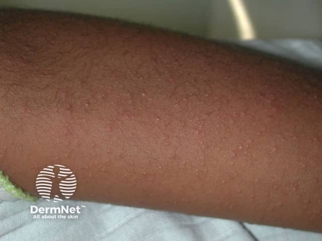 Viral exanthem