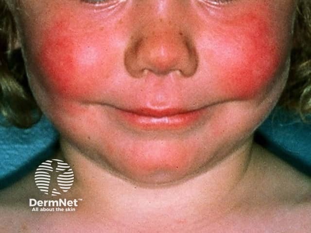 Erythema infectiosum