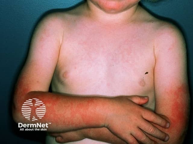 Erythema infectiosum