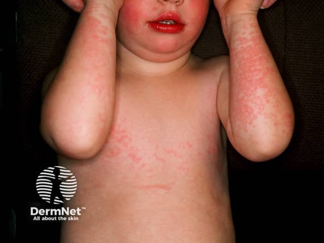 Erythema infectiosum