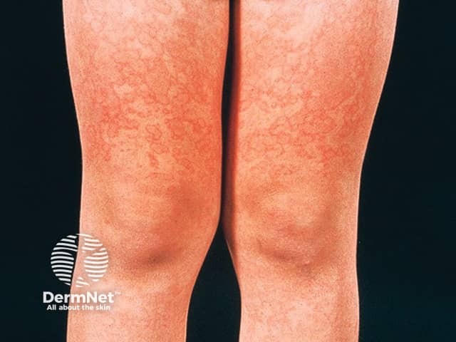 Erythema infectiosum