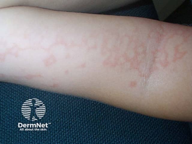 Erythema infectiosum