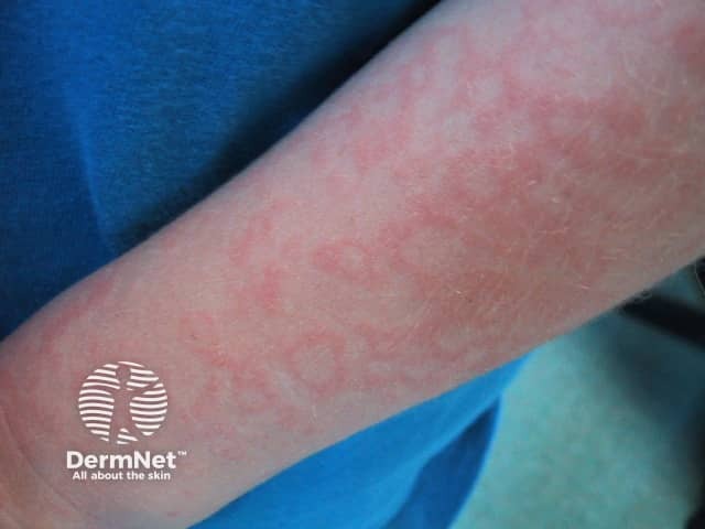 Erythema infectiosum