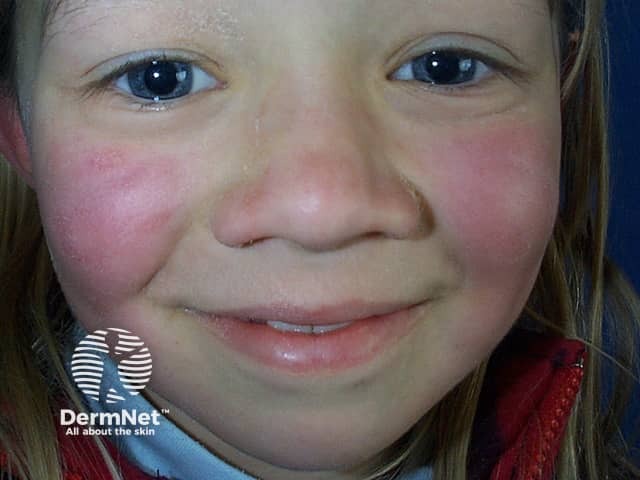 Erythema infectiosum