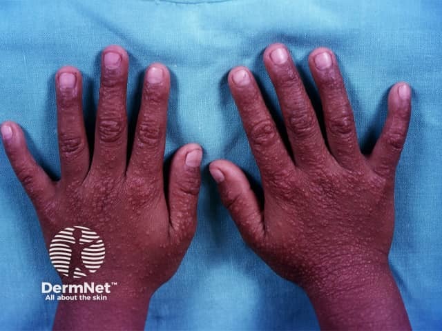 Gianotti-Crosti syndrome