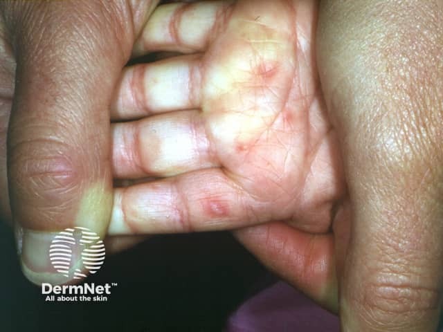 Hand, foot and mouth disease