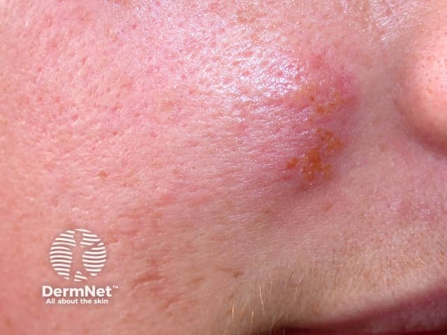 Herpes simplex on the cheek