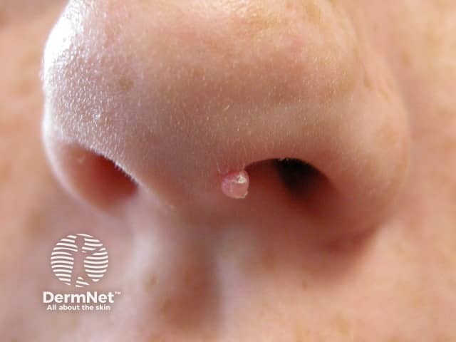 Molluscum contagiosum